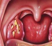 Tonsilitis eritematosa sifilis